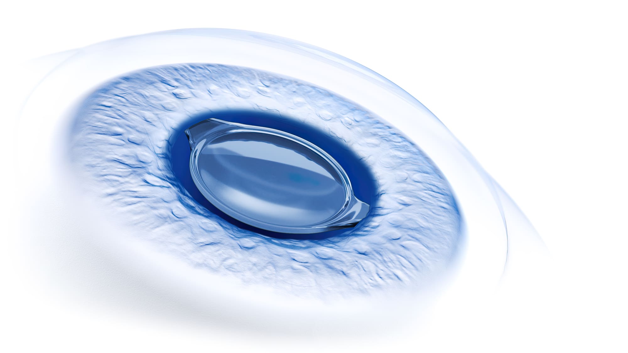 ZEISS Cataract Workflow: Llevando la cirugía de catarata al siguiente nivel