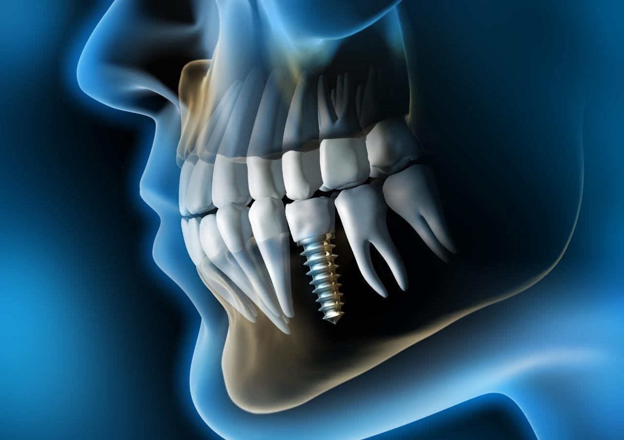 XX Congreso Nacional e Internacional del Colegio Mexicano de Implantología Bucal y Maxilofacial A.C.